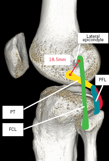 Open Anatomic Reconstruction of the Medial Collateral Ligament and  Posteromedial Corner - ScienceDirect